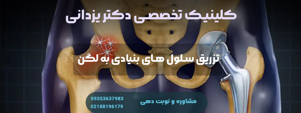 تزریق سلول های بنیادی به لگن